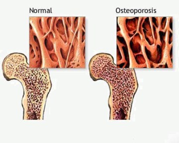 Как лечить остеопороз. Остеопороз.